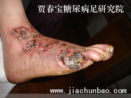 糖尿病民間奇方，怕失傳了 - 瀛子 - 瀛の小箋