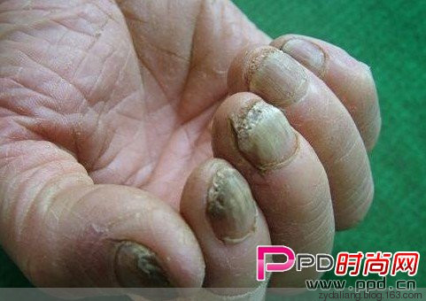 治愈灰指甲，幾乎是百分之一百 - 瀛子 - 瀛の小箋