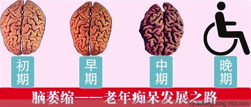 神奇的耳鳴和腦萎縮偏方 - 瀛子 - 瀛の小箋