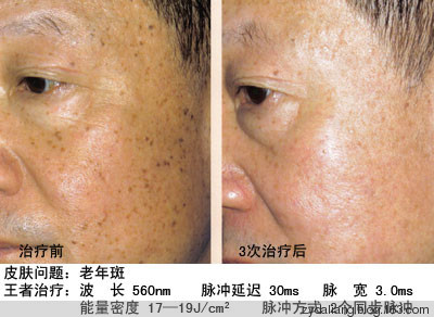老年斑效方 - RJZhYiWD - 人間正義無敵 老年斑效方【美容秘方】 - 瀛子 - 瀛の小箋